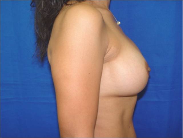 aumento de senos con implantes anatomicos